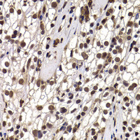 Immunohistochemistry of paraffin-embedded Human kidney cancer using DDX21 Polyclonal Antibody at dilution of 1:100 (40x lens) .