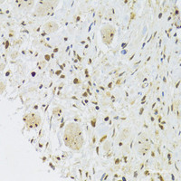 Immunohistochemistry of paraffin-embedded Human gastric cancer using EFTUD2 Polyclonal Antibody at dilution of 1:100 (40x lens) .
