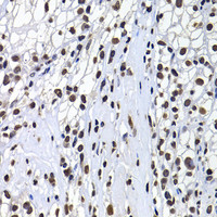 Immunohistochemistry of paraffin-embedded Human kidney cancer using mH2A1 Polyclonal Antibody at dilution of 1:100 (40x lens) .