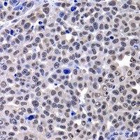 Immunohistochemistry of paraffin-embedded Mouse lung cancer using mH2A1 Polyclonal Antibody at dilution of 1:100 (40x lens) .