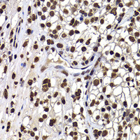 Immunohistochemistry of paraffin-embedded Human kidney cancer using DNAJB6 Polyclonal Antibody at dilution of 1:100 (40x lens) .