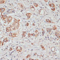 Immunohistochemistry of paraffin-embedded Human liver cancer using TES Polyclonal Antibody at dilution of 1:100 (40x lens) .