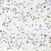 Immunohistochemistry of paraffin-embedded Human lung cancer using TRMT2A Polyclonal Antibody at dilution of 1:100 (40x lens) .