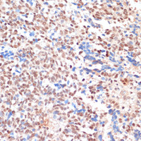 Immunohistochemistry of paraffin-embedded Human oophoroma using NAA20 Polyclonal Antibody at dilution of 1:100 (40x lens) .