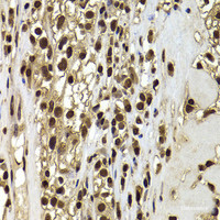 Immunohistochemistry of paraffin-embedded Human kidney cancer using ACTL6B Polyclonal Antibody at dilution of 1:100 (40x lens) .