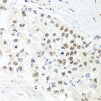 Immunohistochemistry of paraffin-embedded Human lung cancer using TRMT1 Polyclonal Antibody at dilution of 1:100 (40x lens) .
