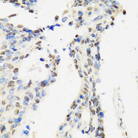 Immunohistochemistry of paraffin-embedded Human rectal cancer using CCAR2 Polyclonal Antibody at dilution of 1:100 (40x lens) .