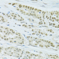 Immunohistochemistry of paraffin-embedded Human colon carcinoma using FIP1L1 Polyclonal Antibody at dilution of 1:100 (40x lens) .