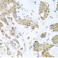 Immunohistochemistry of paraffin-embedded Human gastric cancer using ALKBH8 Polyclonal Antibody at dilution of 1:100 (40x lens) .