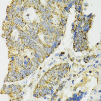 Immunohistochemistry of paraffin-embedded Human colon carcinoma using IDH2 Polyclonal Antibody at dilution of 1:100 (40x lens) .