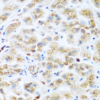 Immunohistochemistry of paraffin-embedded Human liver cancer using KIAA1456 Polyclonal Antibody at dilution of 1:200 (40x lens) .