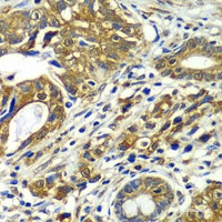 Immunohistochemistry of paraffin-embedded Human gastric cancer using CDC16 Polyclonal Antibody at dilution of 1:100 (40x lens) .
