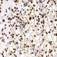 Immunohistochemistry of paraffin-embedded Human kidney cancer using PHIP Polyclonal Antibody at dilution of 1:100 (40x lens) .