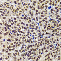 Immunohistochemistry of paraffin-embedded Mouse tumor using PHIP Polyclonal Antibody at dilution of 1:100 (40x lens) .