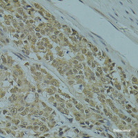 Immunohistochemistry of paraffin-embedded Human colon carcinoma using RSRC1 Polyclonal Antibody at dilution of 1:100 (40x lens) .