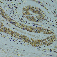 Immunohistochemistry of paraffin-embedded Human breast cancer using RSRC1 Polyclonal Antibody at dilution of 1:100 (40x lens) .