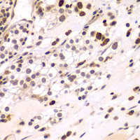 Immunohistochemistry of paraffin-embedded Human kidney cancer using CEBPG Polyclonal Antibody at dilution of 1:100 (40x lens) .