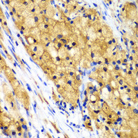 Immunohistochemistry of paraffin-embedded Human lung cancer using CAPG Polyclonal Antibody at dilution of 1:100 (40x lens) .