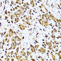 Immunohistochemistry of paraffin-embedded Human gastric cancer using KU70 Polyclonal Antibody at dilution of 1:100 (40x lens) .