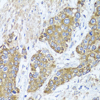 Immunohistochemistry of paraffin-embedded Human prostate cancer using PEX14 Polyclonal Antibody at dilution of 1:100 (40x lens) .