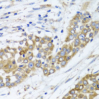 Immunohistochemistry of paraffin-embedded Human colon carcinoma using PEX14 Polyclonal Antibody at dilution of 1:100 (40x lens) .