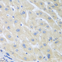 Immunohistochemistry of paraffin-embedded Human liver cancer using PON1 Polyclonal Antibody at dilution of 1:100 (40x lens) .