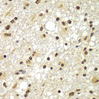 Immunohistochemistry of paraffin-embedded Human brain cancer using ZNF20 Polyclonal Antibody at dilution of 1:100 (40x lens) .
