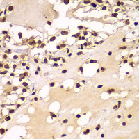 Immunohistochemistry of paraffin-embedded Human kidney cancer using ZNF20 Polyclonal Antibody at dilution of 1:100 (40x lens) .