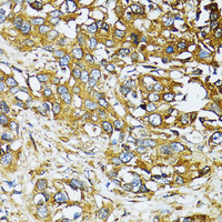 Immunohistochemistry of paraffin-embedded Human liver cancer using ATG7 Polyclonal Antibody at dilution of 1:100 (40x lens) .