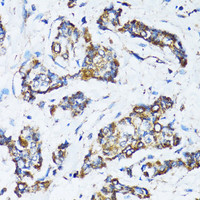 Immunohistochemistry of paraffin-embedded Human breast cancer using ATG7 Polyclonal Antibody at dilution of 1:100 (40x lens) .
