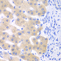 Immunohistochemistry of paraffin-embedded Human liver cancer using CYP2C18 Polyclonal Antibody at dilution of 1:100 (40x lens) .