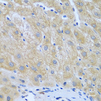 Immunohistochemistry of paraffin-embedded Human liver cancer using FURIN Polyclonal Antibody at dilution of 1:100 (40x lens) .
