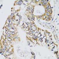 Immunohistochemistry of paraffin-embedded Human gastric cancer using CHN1 Polyclonal Antibody at dilution of 1:100 (40x lens) .