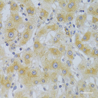 Immunohistochemistry of paraffin-embedded Human liver cancer using EIF4G1 Polyclonal Antibody at dilution of 1:100 (40x lens) .