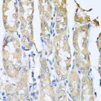 Immunohistochemistry of paraffin-embedded Human gastric cancer using CCL3 Polyclonal Antibody at dilution of 1:100 (40x lens) .