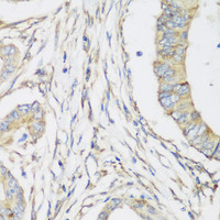 Immunohistochemistry of paraffin-embedded Human colon carcinoma using SH3GLB2 Polyclonal Antibody at dilution of 1:200 (40x lens) .