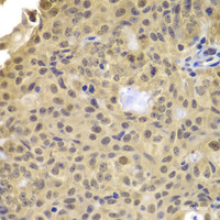 Immunohistochemistry of paraffin-embedded Human well-differentiated squamous skin carcinoma using Cyclin A2 Polyclonal Antibody at dilution of 1:100 (40x lens) .