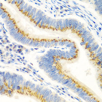 Immunohistochemistry of paraffin-embedded Human colon carcinoma using UBIAD1 Polyclonal Antibody at dilution of 1:100 (40x lens) .