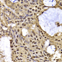 Immunohistochemistry of paraffin-embedded Human oophoroma using ARID3A Polyclonal Antibody at dilution of 1:100 (40x lens) .