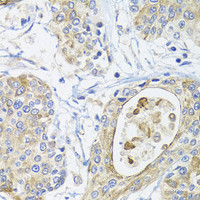 Immunohistochemistry of paraffin-embedded Human prostate cancer using GSTA2 Polyclonal Antibody at dilution of 1:100 (40x lens) .