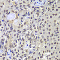 Immunohistochemistry of paraffin-embedded Human well-differentiated squamous skin carcinoma using PRKDC Polyclonal Antibody at dilution of 1:100 (40x lens) .