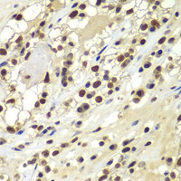 Immunohistochemistry of paraffin-embedded Human kidney cancer using PRKDC Polyclonal Antibody at dilution of 1:100 (40x lens) .