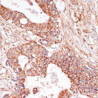 Immunohistochemistry of paraffin-embedded Human colon carcinoma using MAP2K3 Polyclonal Antibody at dilution of 1:100 (40x lens) .