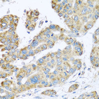 Immunohistochemistry of paraffin-embedded Human liver cancer using SYT4 Polyclonal Antibody at dilution of 1:100 (40x lens) .