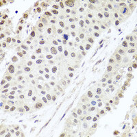 Immunohistochemistry of paraffin-embedded Human lung cancer using ALKBH4 Polyclonal Antibody at dilution of 1:100 (40x lens) .