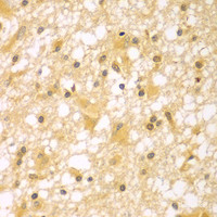 Immunohistochemistry of paraffin-embedded Human brain cancer using PAK6 Polyclonal Antibody at dilution of 1:100 (40x lens) .