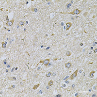 Immunohistochemistry of paraffin-embedded Human brain cancer using RAB17 Polyclonal Antibody at dilution of 1:100 (40x lens) .