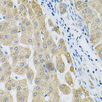 Immunohistochemistry of paraffin-embedded Human liver cancer using ALG2 Polyclonal Antibody at dilution of 1:100 (40x lens) .
