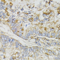 Immunohistochemistry of paraffin-embedded Human gastric cancer using NDUFS7 Polyclonal Antibody at dilution of 1:100 (40x lens) .