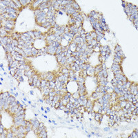 Immunohistochemistry of paraffin-embedded Human colon carcinoma using ACAT2 Polyclonal Antibody at dilution of 1:100 (40x lens) .